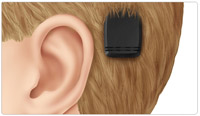 illustration of a bone-anchored aid behind someone's ear