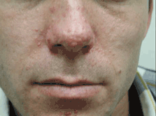lower face showing facial angiofibroma