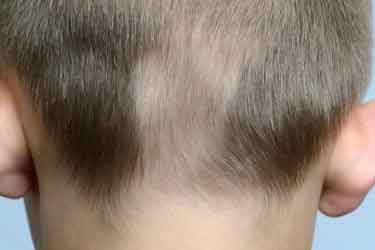 Back of a child's head showing thin patches of hair consistent with Alopecia Areata