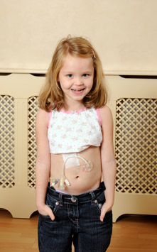 Child wearing tucked up top and showing feeding tube on stomach