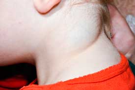 child's neck showing Cystic hygroma