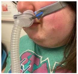 Close-up of a nasal CPAP mask on a young girl with sleep apnea
